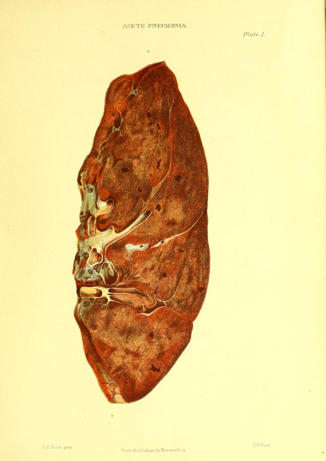 Akutna pneumonija (pneumonia acuta)