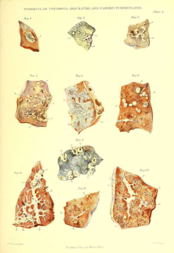 Kazeozna tuberkuloza