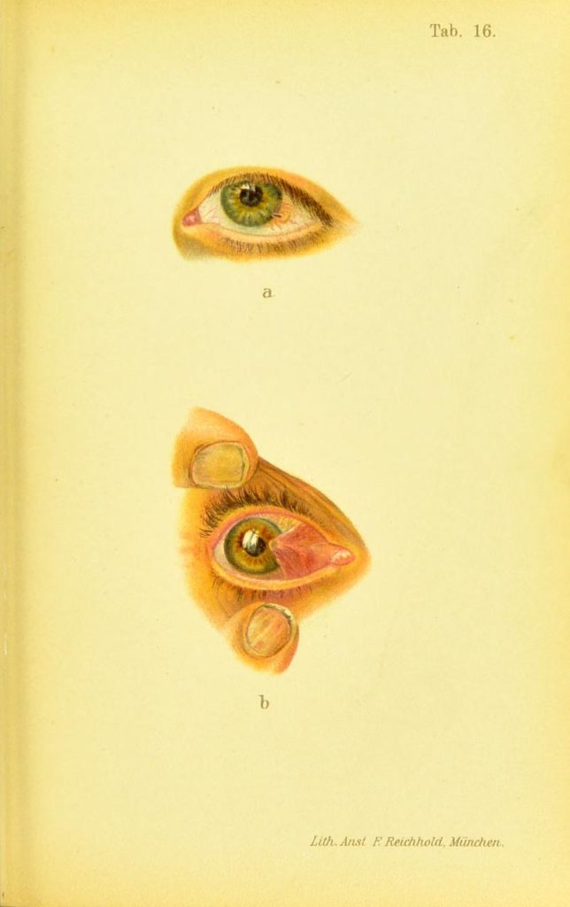 (a) strano telo oka (špon) (b) pterigijum oka