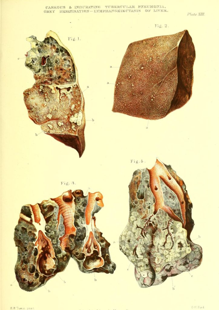 Tuberkulozna pneumonija