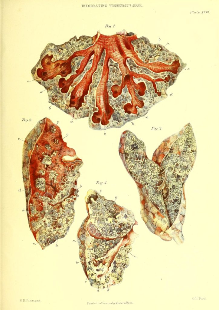 Indurirajuća tuberkulozna pneumonija