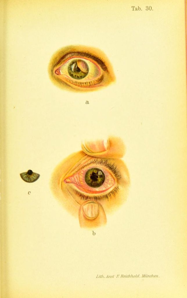 (a) Sarkom irisa (b) Sifilitični iritis