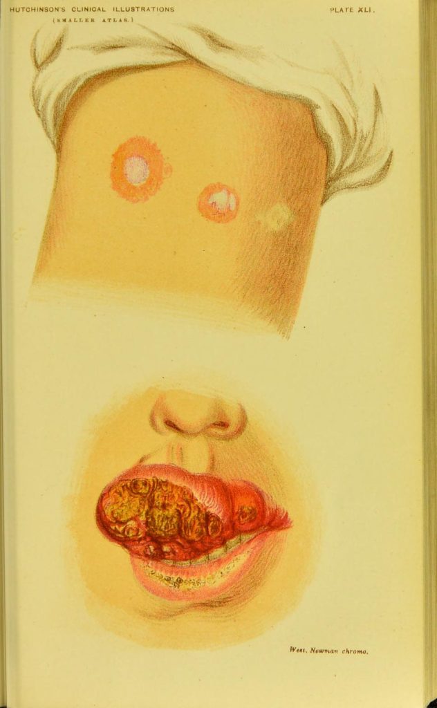 Karcinom usne