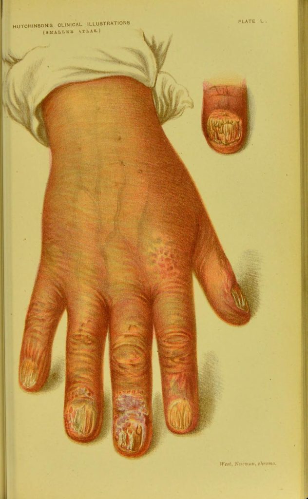 Akrodermatitis i bolesti nokta