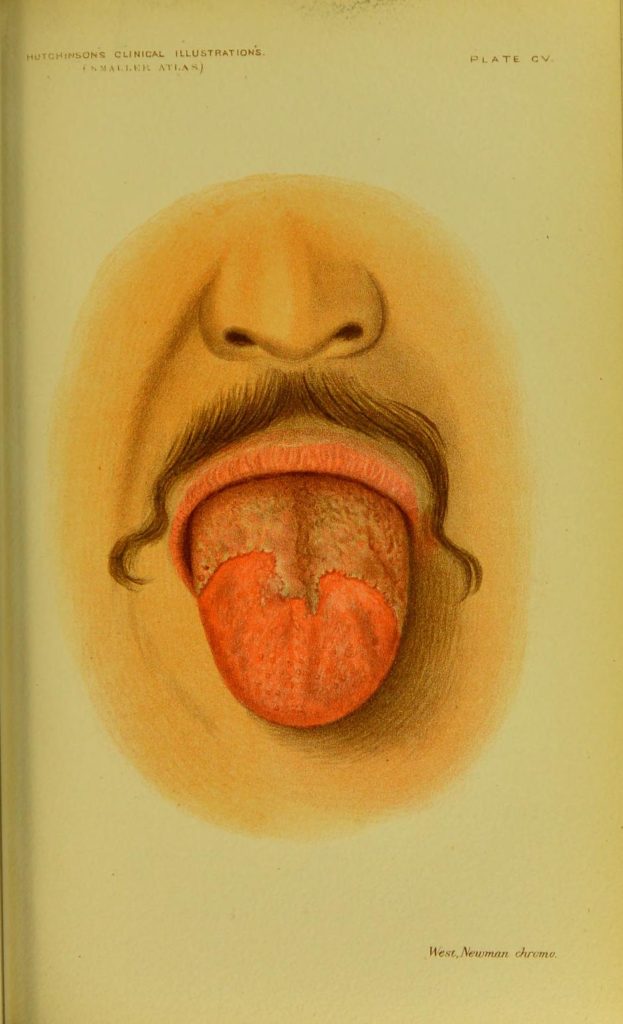 Sekundarni sifilis, promene na jeziku
