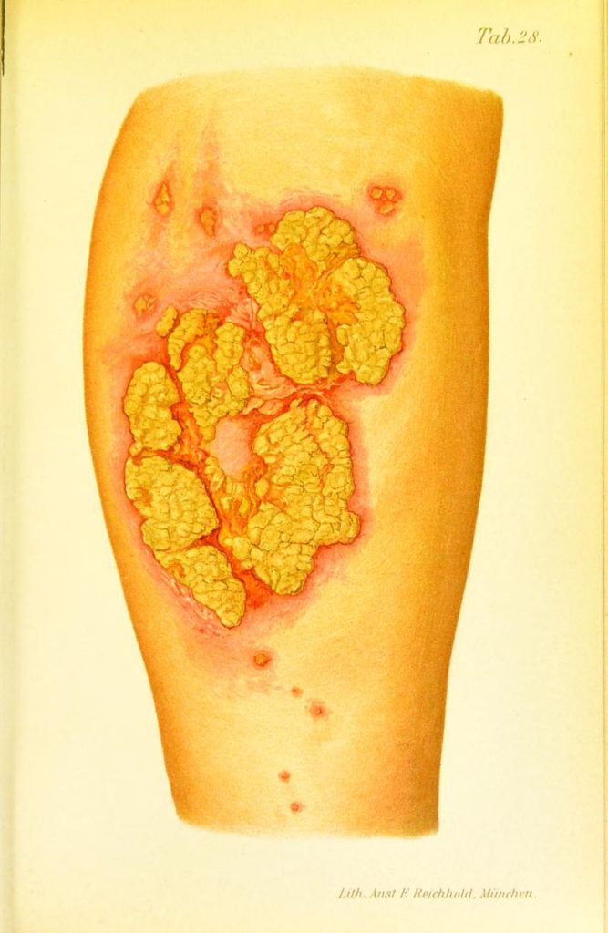 Eczema Madidans et Crustosum