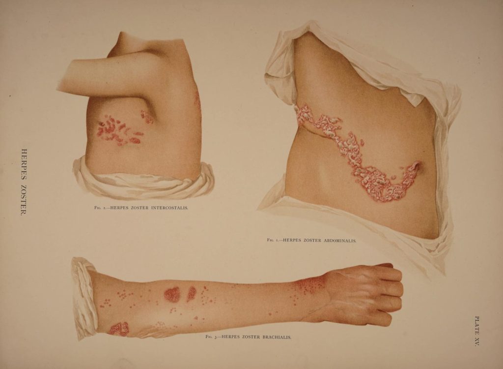 Herpes Zoster