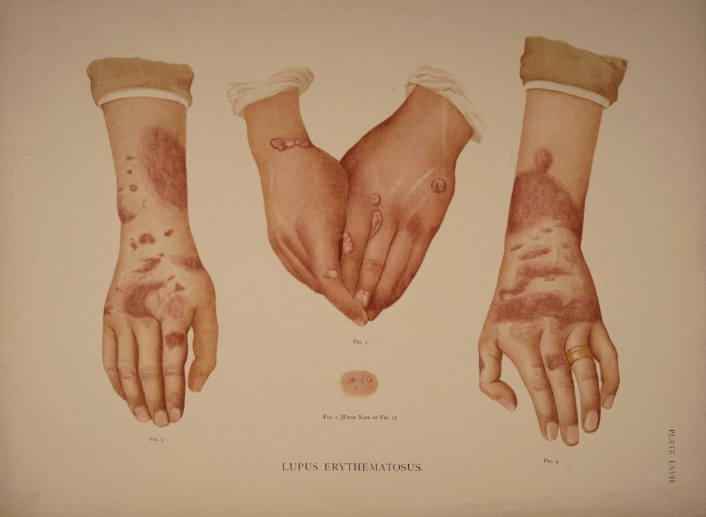 Lupus Erythematosus