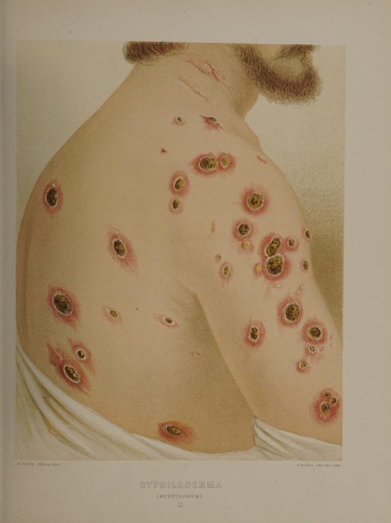 Syphiloderma