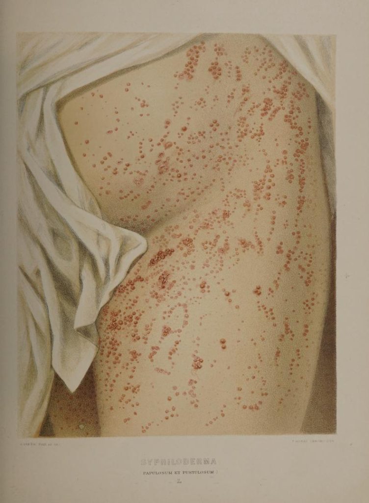 Syphiloderma