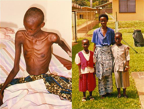 Slim disease, HIV enteropatija, oboleli od HIV-a, atrofija vilusa, HIV, AIDS